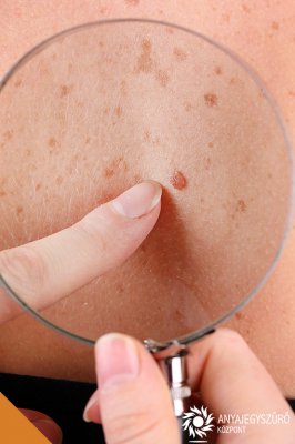 Mi a melanoma?