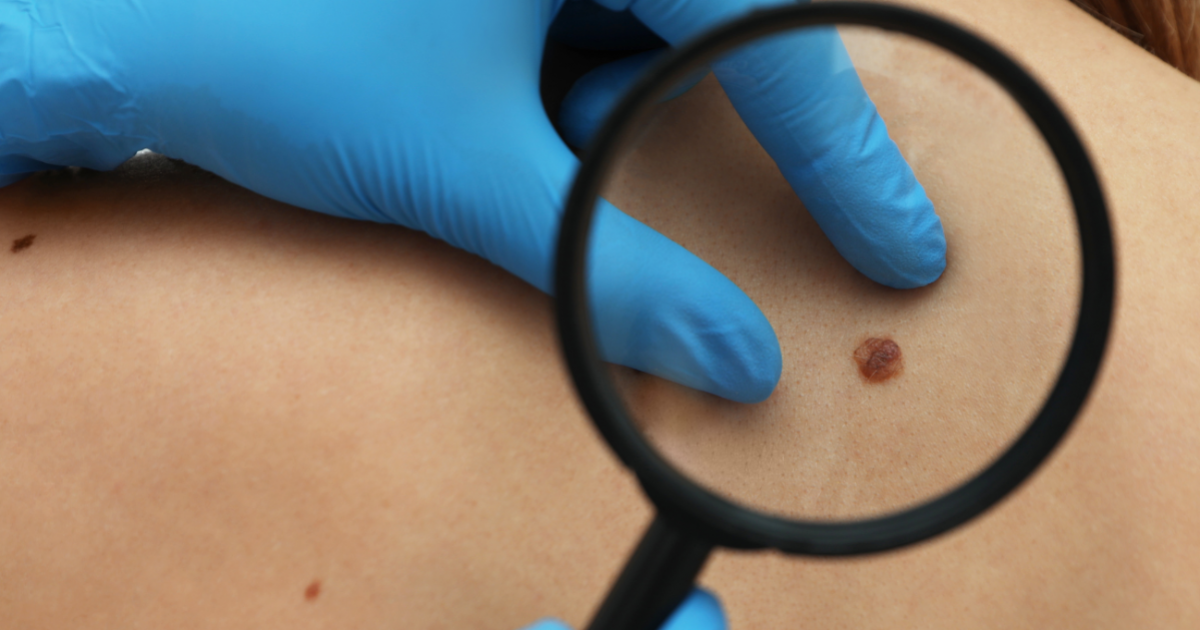 Ingyenes Melanoma Szres