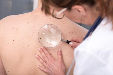 Melanoma diagnózis -  egy valós történet háttere