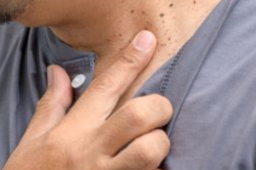 Bőrrákszűrés - nem csak a nagy, feltűnő anyajegy a gyanús