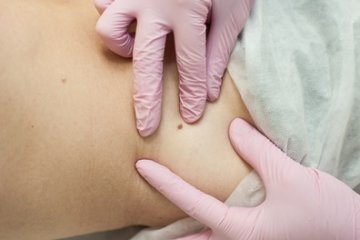 Melanoma megelőzés: miért nem elég a fényvédelem és az önvizsgálat? 