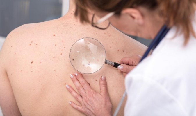 Melanoma diagnózis -  egy valós történet háttere