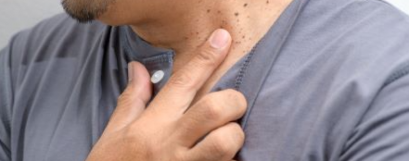 Bőrrákszűrés - nem csak a nagy, feltűnő anyajegy a gyanús