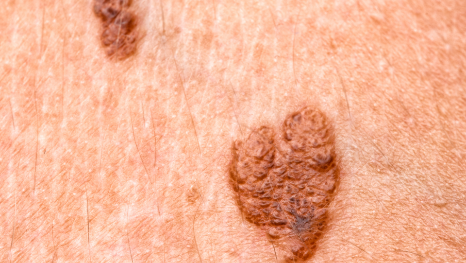 A melanoma kialakulásának kockázati tényezői