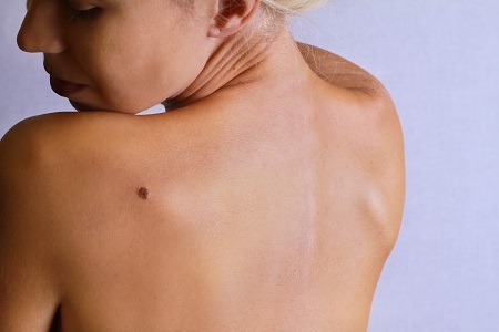 A bőrrák, a basalioma kezelésében döntő a korai felismerés.
