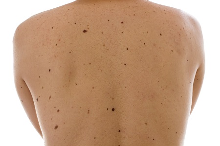 Szoláriumozóknak is fontos az évenkénti bőrrák szűrés.