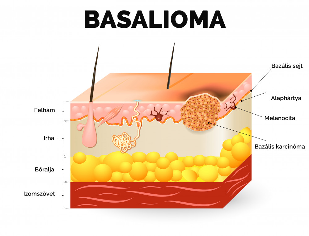 Magas basalioma-kockázat esetén fontos a rendszeres anyajegyszűrés.