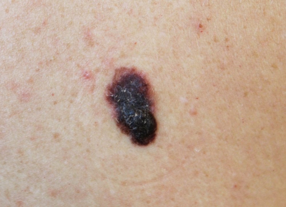 A melanoma korai felismerése életet menthet.